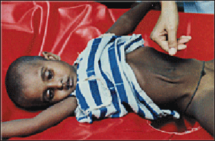 20110306-cholere cdc Male-child-w-cholera.gif